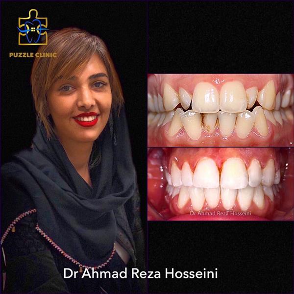 درمان ارتودنسی ثابت فک بالا و پایین توسط دکتر احمدرضتا حسینی، متخصص ارتودنسی دندان