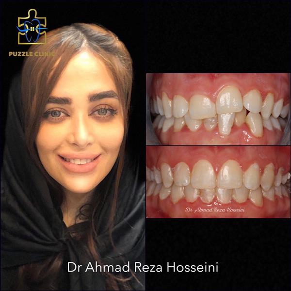 ارتودنسی بدون کشیدن دندان، درمان توسط دکتر احمدرضا حسینی