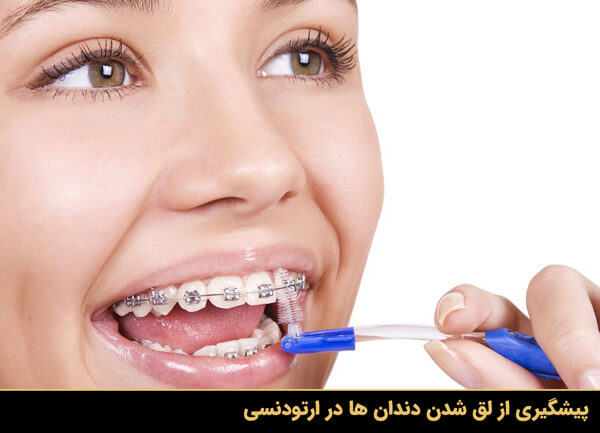 پیشگیری از لق شدن دندان ها در ارتودنسی