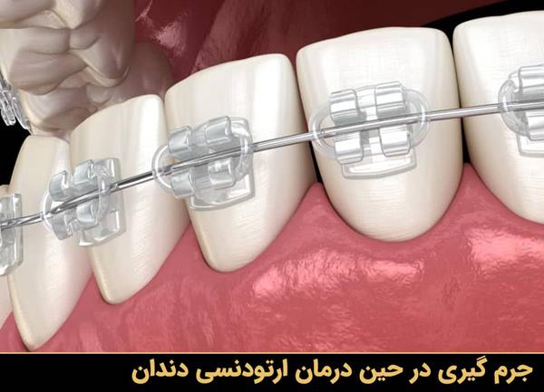 جرم گیری در حین درمان ارتودنسی دندان
