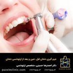 جرم گیری دندان قبل، حین و بعد از ارتودنسی دندان