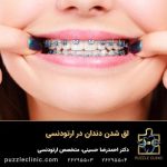 لق شدن دندان در ارتودنسی | آیا ارتودنسی سبب لق شدن دندان میشود؟