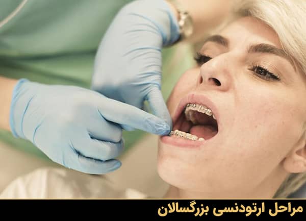 مراحل ارتودنسی دندان بزرگسالان