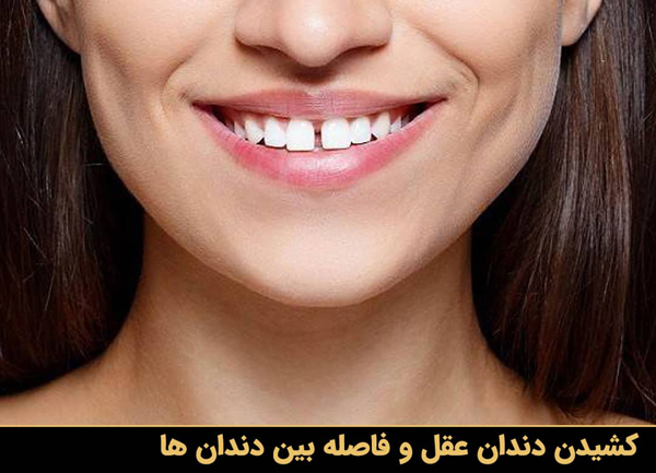 کشیدن دندان عقل و فاصله بین دندان ها