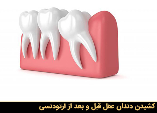 کشیدن دندان عقل قبل و بعد از ارتودنسی