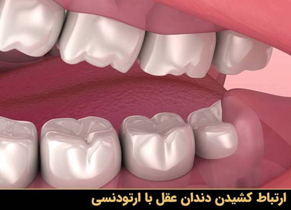 ارتباط کشیدن دندان عقل با ارتودنسی
