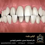 کراس بایت دندان | علل ایجاد کراس بایت | درمان کراس بایت با ارتودنسی