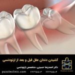 کشیدن دندان عقل قبل حین و بعد از ارتودنسی + نکات کلیدی و مهم