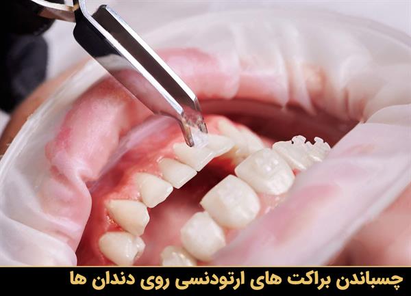 چسباندن براکت های ارتودنسی روی دندان ها