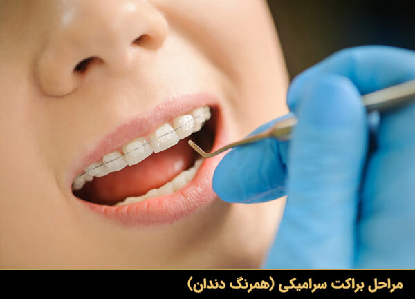 مراحل براکت سرامیکی (همرنگ دندان)