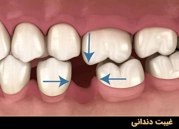 غیبت دندانی