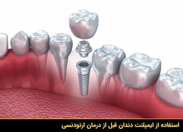 استفاده از ایمپلنت دندان قبل از درمان ارتودنسی