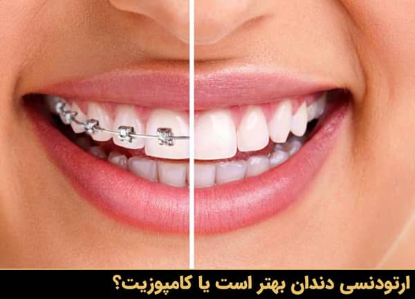 ارتودنسی دندان بهتر است یا کامپوزیت؟