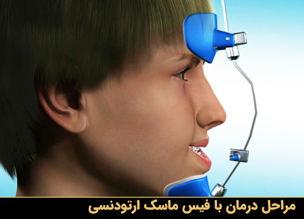 مراحل درمان با فیس ماسک ارتودنسی