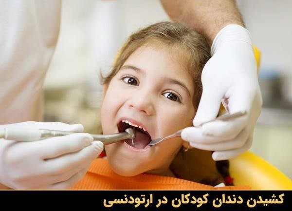 کشیدن دندان کودکان در ارتودنسی
