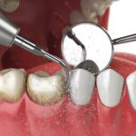 جرم گیری دندان (بروساژ دندان) چیست؟ +مزایا،معایب و هزینه 1403