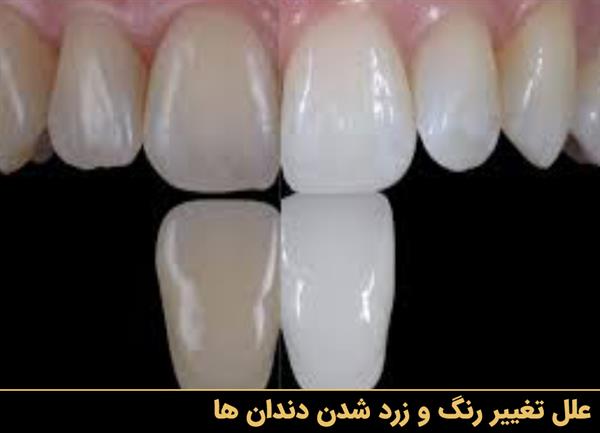 علل تغییر رنگ و زرد شدن دندان ها