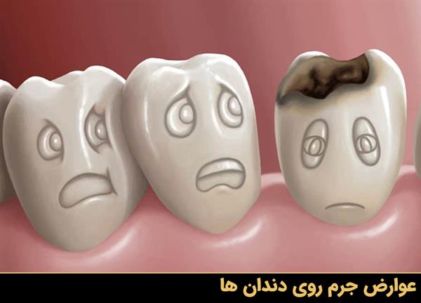 عوارض جرم روی دندان ها