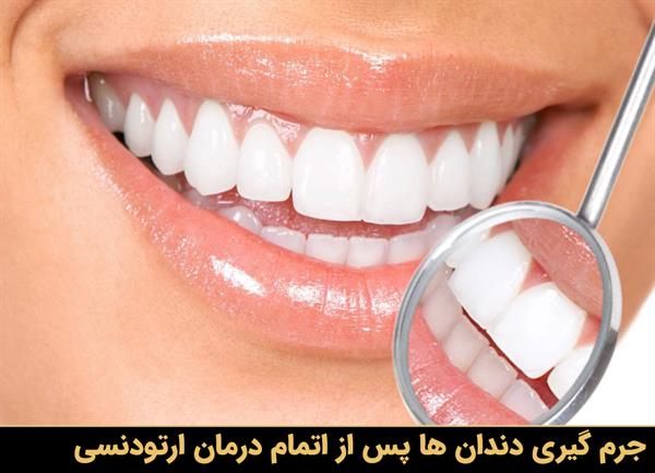 جرم گیری دندان ها پس از اتمام درمان ارتودنسی