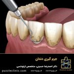 جرم گیری دندان (بروساژ دندان) چیست؟ +مزایا،معایب و هزینه 1403