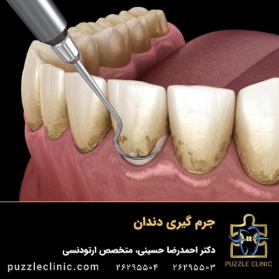 جرم گیری دندان (بروساژ دندان) چیست؟