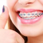 4 راهکار سفید کردن دندان ها حین درمان ارتودنسی + مزایا و معایب