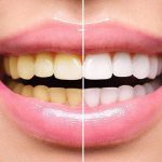 9 دلیل زرد شدن دندان حین ارتودنسی + راهکارهای پیشگیری و درمان