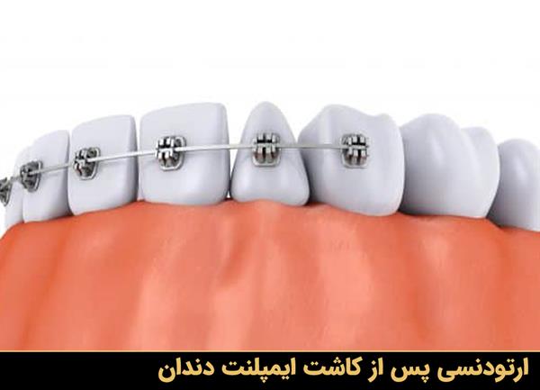 ارتودنسی پس از کاشت ایمپلنت دندان