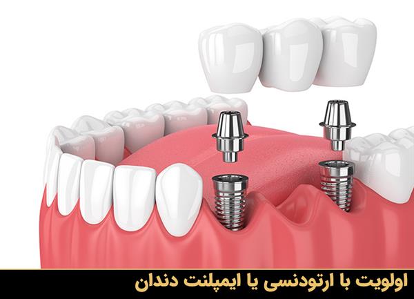 اولویت با ارتودنسی یا ایمپلنت دندان