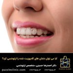 آیا می توان دندان های کامپوزیت شده را ارتودنسی کرد؟