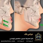 جراحی فک و صورت (جراحی ارتوگناتیک) | مزایا، عوارض و مراقبتها