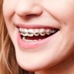 نقش ارتودنسی در دندانپزشکی زیبایی | تاثیر ارتودنسی بر چانه و صورت
