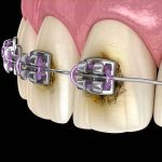 پوسیدگی دندان حین ارتودنسی + 5 راهکار پیشگیری و درمان