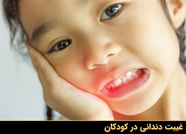 غیبت دندانی در کودکان