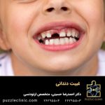 غیبت دندانی چیست؟ | علل ایجاد و عوارض | 4 روش درمانی موثر