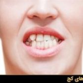 انواع مختلف مال اکلوژن‌ دندانی: 8 عارضه + درمان با ارتودنسی