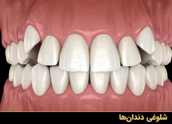 شلوغی دندان‌ها