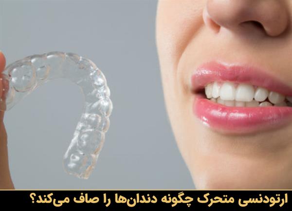 ارتودنسی متحرک چگونه دندان‌ها را صاف می‌کند؟