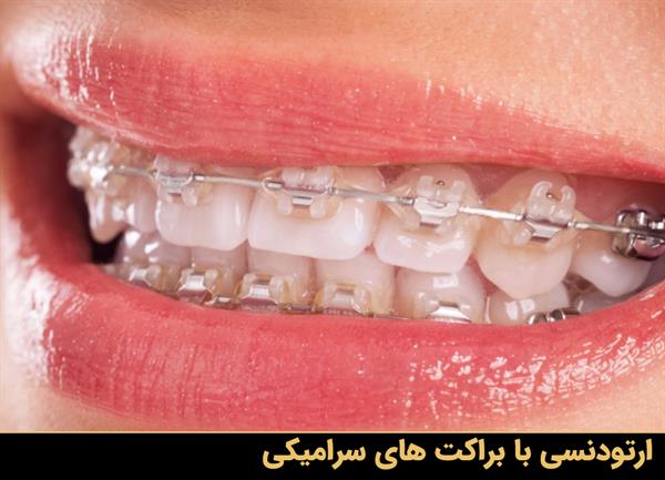 ارتودنسی نامرئی با براکت همرنگ دندان