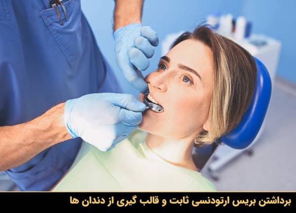 برداشتن بریس ارتودنسی ثابت و قالب گیری از دندان ها