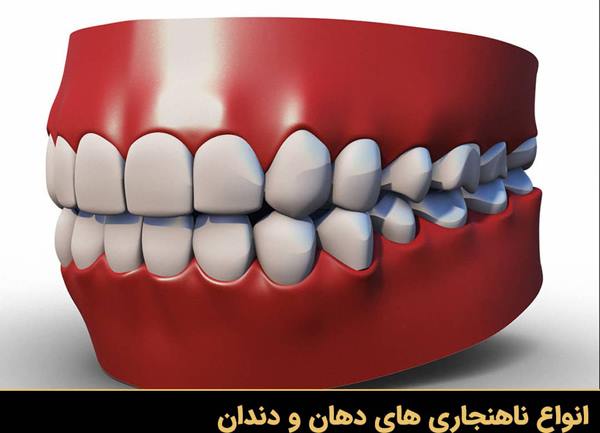 انواع ناهنجاری های دهان و دندان